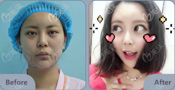 我在北京藝星做面部吸脂案例效果告訴你連凱峰吸脂好不好 我在北京藝星做面部吸脂案例效果告訴你連凱峰吸脂好不好