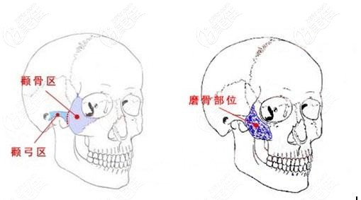 顴骨磨骨的位置 顴骨磨骨的位置
