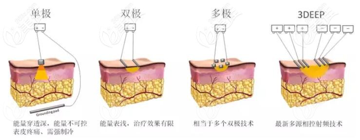 3D相控射頻技術(shù)的優(yōu)勢(shì) 3D相控射頻技術(shù)的優(yōu)勢(shì)