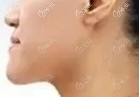 我的骨性地包天臉型圖 我的骨性地包天臉型圖