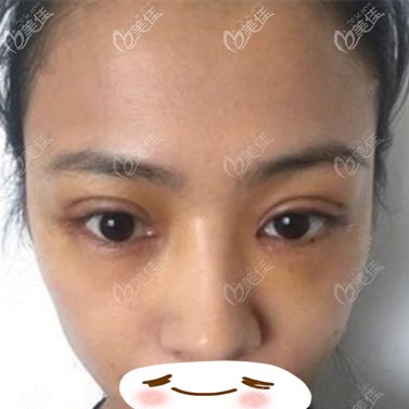 雙眼皮修復術(shù)后5天效果照