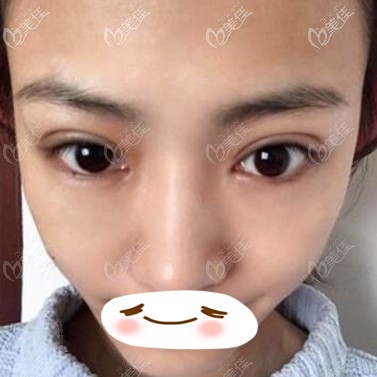 雙眼皮修復術(shù)后10天照