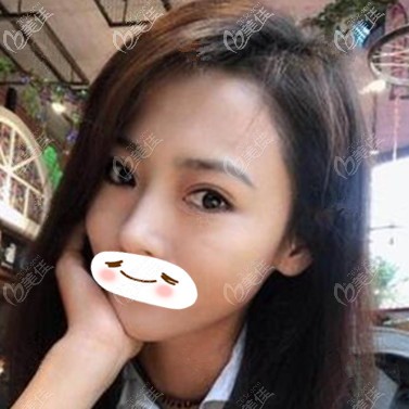 雙眼皮修復術(shù)后20天恢復效果照