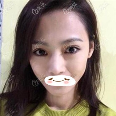 眼修復術(shù)后30天效果照