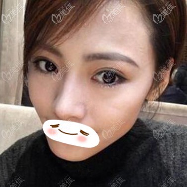 真實經(jīng)歷：得知劉志剛眼修復(fù)做的好后我特地跑到大連找他做了雙眼皮修復(fù)！