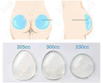 假體豐臀動畫圖示 假體豐臀動畫圖示