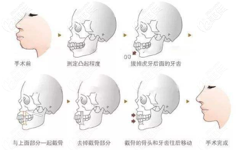 正頜手術(shù)的過程 正頜手術(shù)的過程