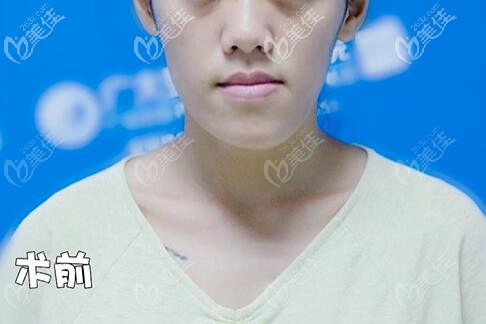 骨性地包天正面臉型 骨性地包天正面臉型