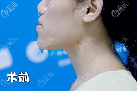 骨性地包天側(cè)面照片 骨性地包天側(cè)面照片