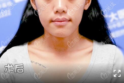 骨性地包天做正頜手術(shù)后40天正面臉型 骨性地包天做正頜手術(shù)后40天正面臉型