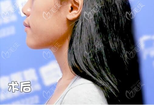 骨性地包天正頜手術(shù)后側(cè)面樣子 骨性地包天正頜手術(shù)后側(cè)面樣子