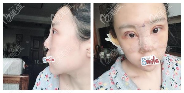 眼鼻綜合術(shù)后第二天變紅腫 眼鼻綜合術(shù)后第二天變紅腫