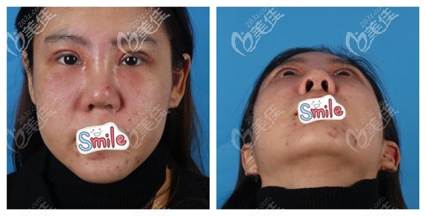 剛做完眼鼻綜合術(shù)后腫脹感強烈 剛做完眼鼻綜合術(shù)后腫脹感強烈