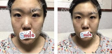 術(shù)前鼻子寬大塌平 術(shù)前鼻子寬大塌平