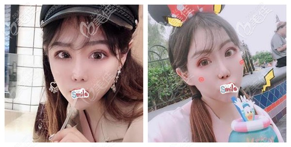 花3小時(shí)選擇全麻方式做了眼鼻綜合手術(shù) 恢復(fù)2個(gè)月我的五官已有較大改變