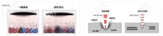 激光祛疤改善過(guò)程示意圖