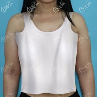 做假體隆胸術(shù)前照 做假體隆胸術(shù)前照