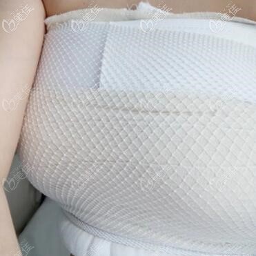 假體隆胸術(shù)后第3天照 假體隆胸術(shù)后第3天照