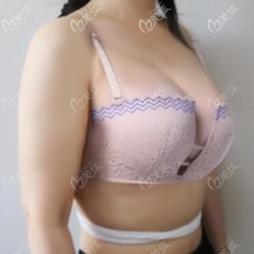 假體隆胸術(shù)后1周恢復(fù)效果照 假體隆胸術(shù)后1周恢復(fù)效果照