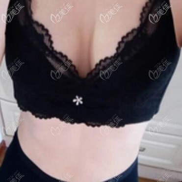 假體隆胸術(shù)后半個(gè)月恢復(fù)效果照片 假體隆胸術(shù)后半個(gè)月恢復(fù)效果照片