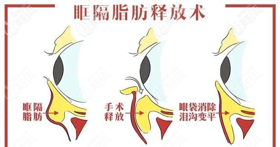 眶隔脂肪釋放術(shù)原理