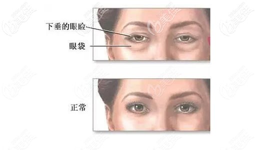 眼袋和淚溝并存的解決方法