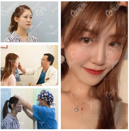 北京玉之光張紅芳面部填充<span style=