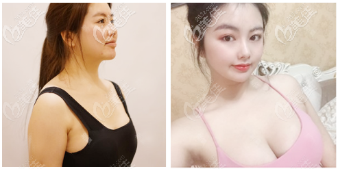 北京玉之光王明利自體脂肪豐胸<span style=