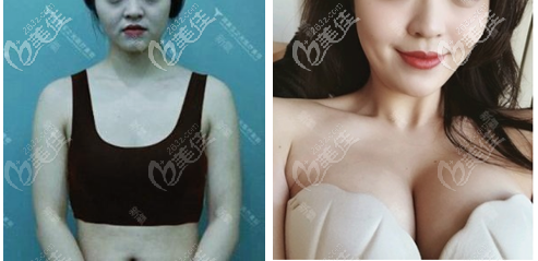 北京玉之光朱金成自體脂肪豐胸<span style=