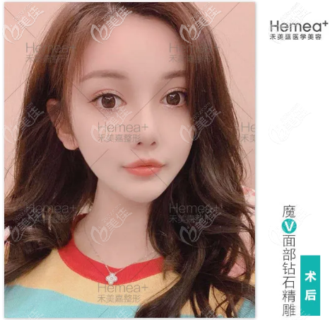 北京禾美嘉任學會自體脂肪面部填充<span style=