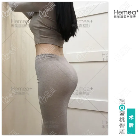 北京禾美嘉任學會自體脂肪豐臀<span style=