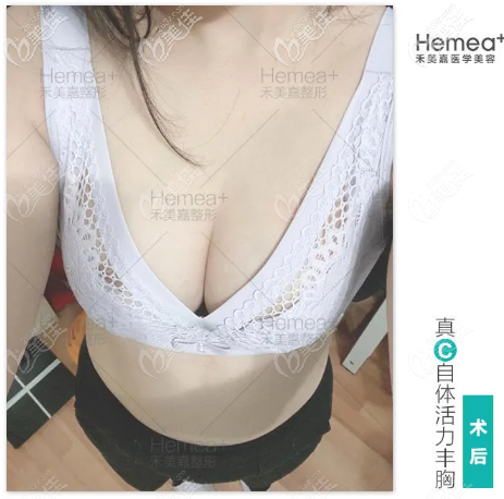 看北京禾美嘉任學會自體脂肪豐胸<span style=