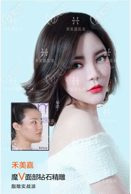 看北京禾美嘉任學會面部吸脂<span style= 看北京禾美嘉任學會面部吸脂<span style=