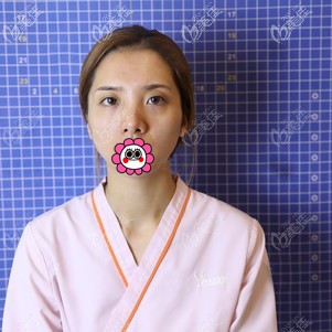 到臺(tái)州藝星做鼻整形前 到臺(tái)州藝星做鼻整形前