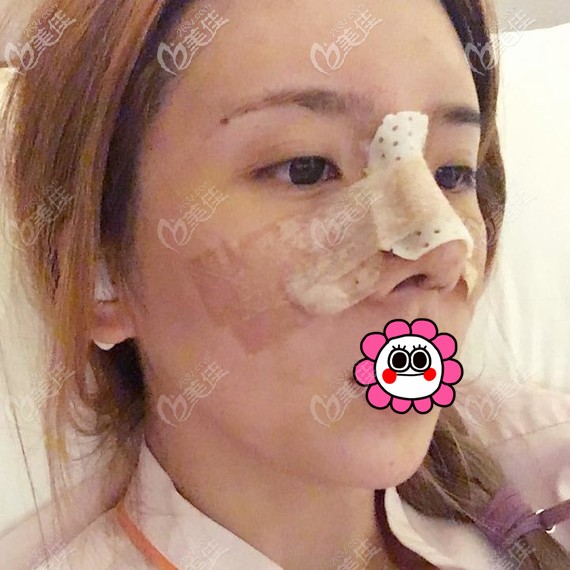 耳軟骨隆鼻術(shù)后即刻 耳軟骨隆鼻術(shù)后即刻