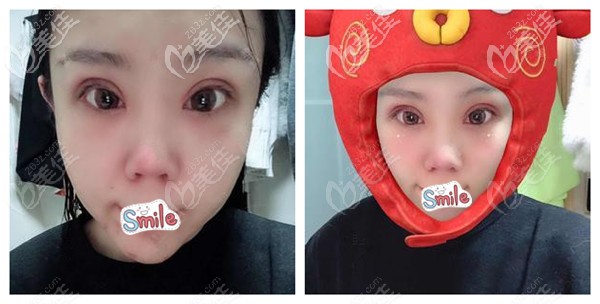 做眼鼻綜合術(shù)后消腫一些 做眼鼻綜合術(shù)后消腫一些