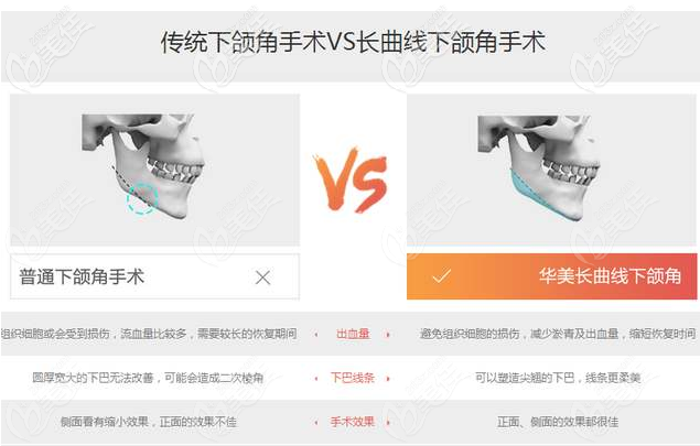 長曲線下頜角手術(shù)對比傳統(tǒng)下頜角手術(shù)優(yōu)勢