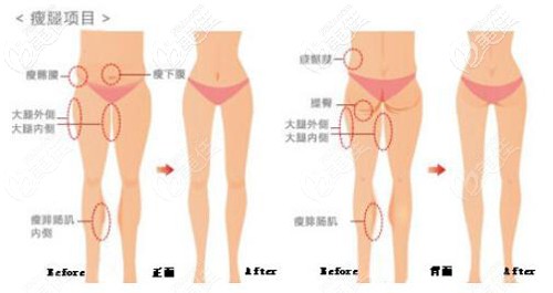 大腿吸脂的范圍