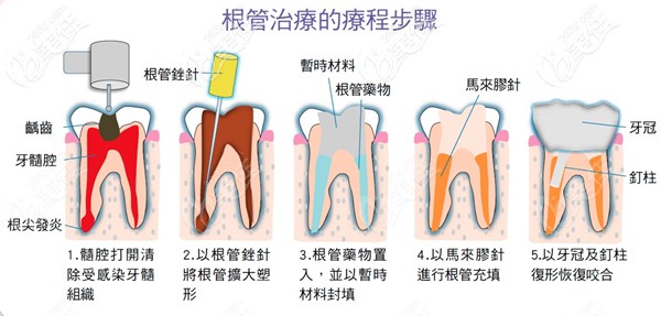 根管治療的過程步驟圖 根管治療的過程步驟圖