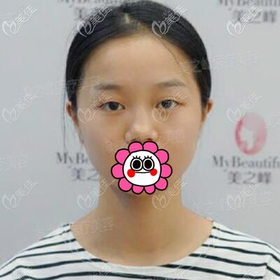 割雙眼皮術(shù)前照 割雙眼皮術(shù)前照