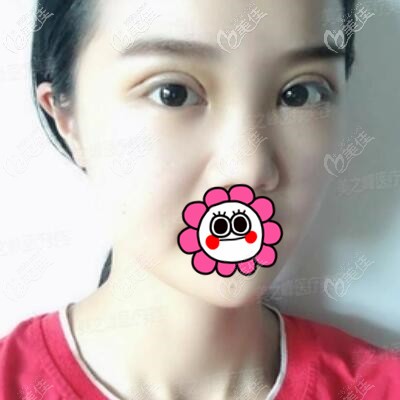 割雙眼皮術(shù)后3天效果照 割雙眼皮術(shù)后3天效果照