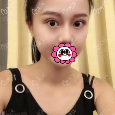 割雙眼皮1個(gè)月時(shí)的恢復(fù)效果照 割雙眼皮1個(gè)月時(shí)的恢復(fù)效果照