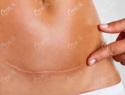 剖腹產(chǎn)后出現(xiàn)的增生疤痕