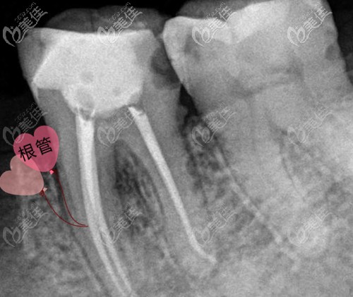 一顆牙根管再治療的費(fèi)用在1000元~1800元左右 一顆牙根管再治療的費(fèi)用在1000元~1800元左右