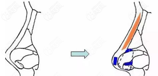 超肋隆鼻手術(shù)效果 超肋隆鼻手術(shù)效果