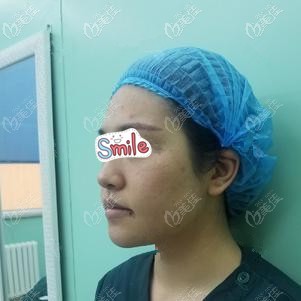 剛做完埋線提升術(shù)后臉腫脹