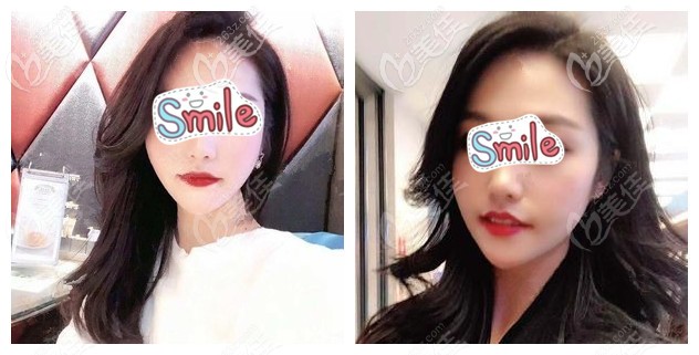 埋線提升術(shù)后15天臉部皮膚緊致