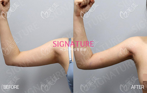 留學(xué)生在韓國(guó)SIGNATURE整形外科做手臂吸脂后自我感覺良好