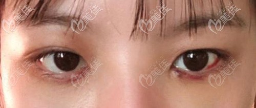 去眼袋后出現(xiàn)明顯紅印