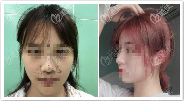 美國(guó)舒鉑鼻綜合案例效果圖 美國(guó)舒鉑鼻綜合案例效果圖